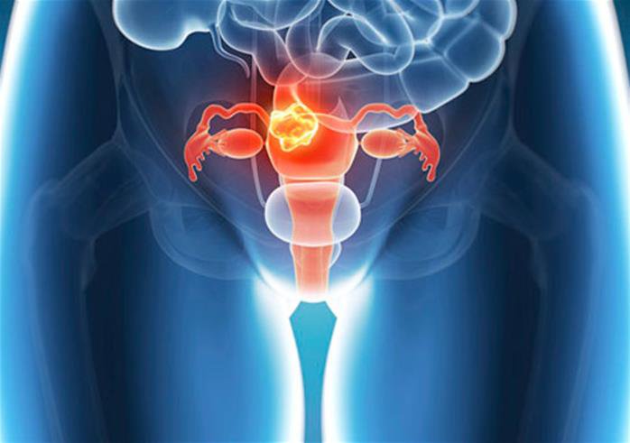 endometriosis-el-dolor-y-la-infertilidad-son-los-sintomas-frecuentes